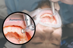 Lupas dentales Sport Flip-Up con visión precisa para dentistas