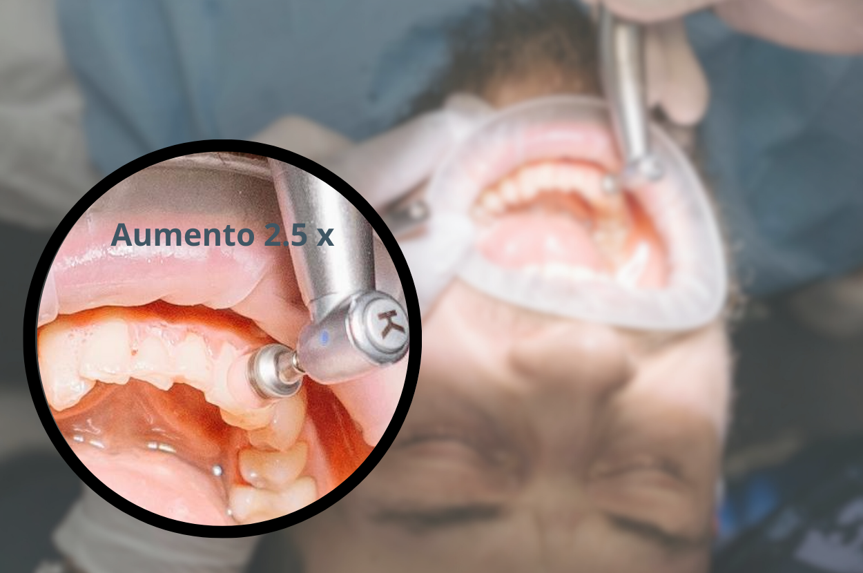 Lupas dentales Sport Flip-Up con visión precisa para dentistas